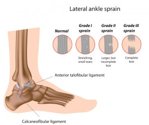 anklesprain3