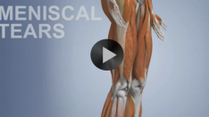 meniscal tearsFI