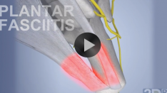 FI_plantarfasciitis